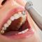 Ce este și cum ne ajută detartrajul dentar?